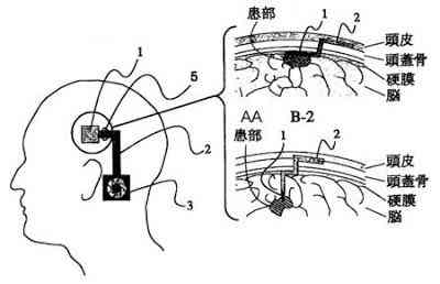 Japoneses patentearam um ar condicionado cerebral brain radiator | Bizarro | biônicos, bizarrice, bizarro, japão, medicina