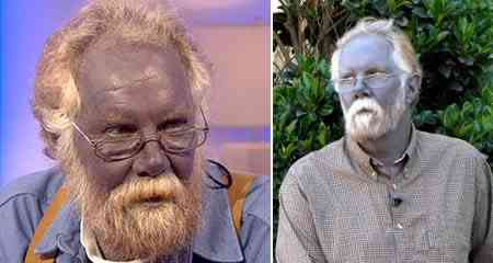 O homem que ficou azul homem da pele azul | Bizarro | absurdo, bizarrice, bizarro, curioso, incrível, mutante, notícia, sinistro