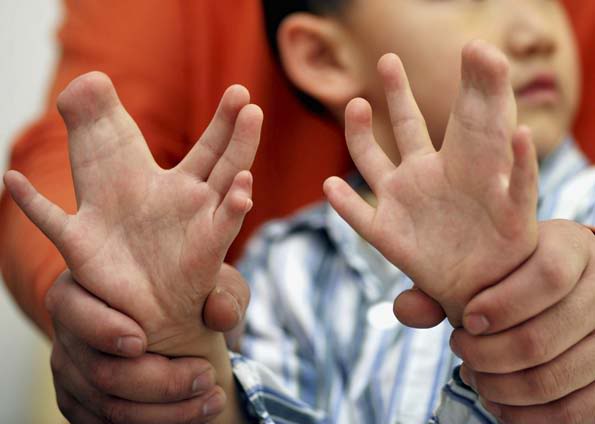 Conheça o menino que tem 16 dedos nos pés e 15 dedos nas mãos Photobucket