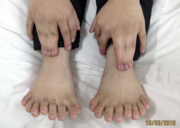 Conheça o menino que tem 16 dedos nos pés e 15 dedos nas mãos Photobucket