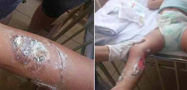 Mãe do ano! Mulher abandona o filho de 1 aninho após tatuá-lo e tentar remover o desenho com produto químico d98abbe0-b05a-11e3-9baf-4f06aeb601db_630perna