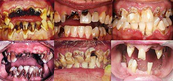 15 bizarrices envolvendo dentes Faz sucesso na micareta