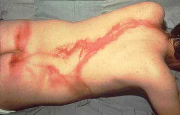 Lichtenberg figure, o mais estranho tipo de marca corporal 1-s2-0-s0305417907002987-gr2