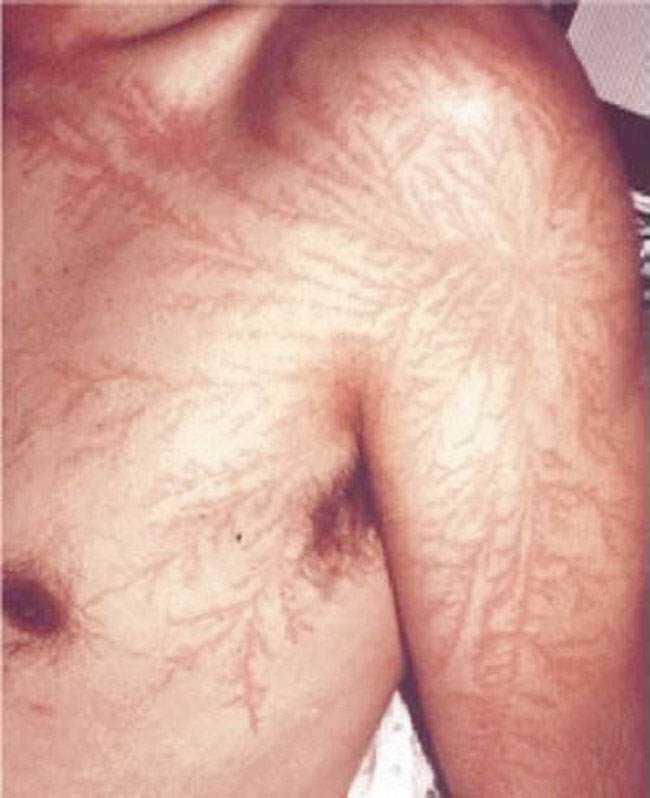 Sujeito azarado é atingido por raios duas vezes na mesma semana lightning strike scar lichtenberg figure 2 | Bizarro | bizarro, curioso, raios
