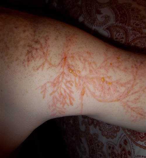 Lichtenberg figure, o mais estranho tipo de marca corporal lightning-strike-scar-lichtenberg-figure-5