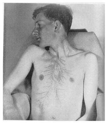 Lichtenberg figure, o mais estranho tipo de marca corporal tumblr_m6h9cupgCm1qbbl1co6_400