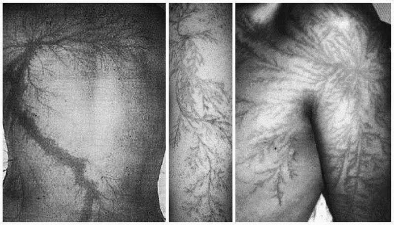 Lichtenberg figure, o mais estranho tipo de marca corporal unnamed (7)
