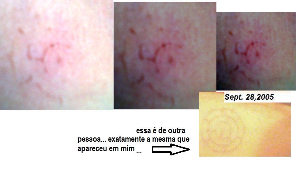 O que são as marcas misteriosas que estão aparecendo nas pessoas? unnamed