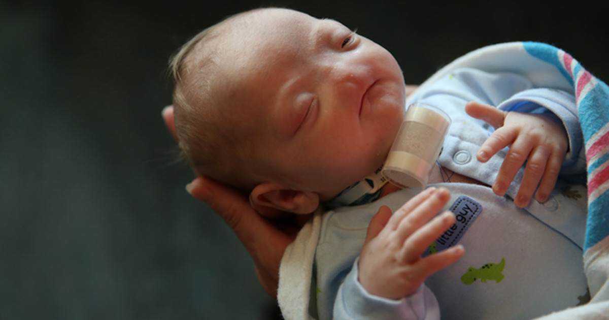 Bebê nasce sem nariz nos EUA. Veja fotos! eli-baby